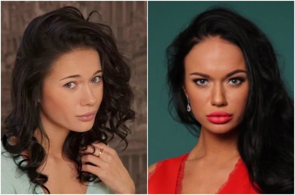 Яна Кошкина до и после пластики, фото